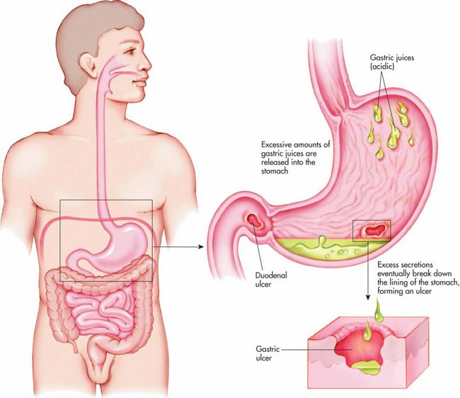 Ubat Gastrik Paling Mujarab Dan Terbukti Berkesan 
