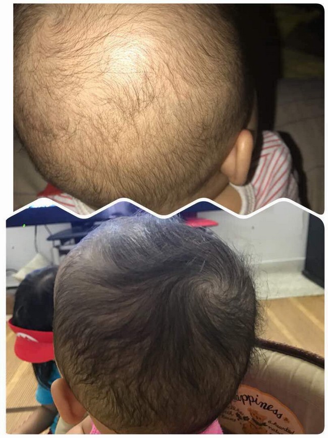 Punca Rambut Bayi Nipis Dan Cara Melebatkan Rambut Dari Kecil